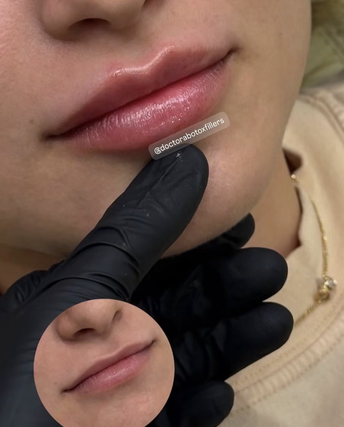 Relleno de labios: antes y después