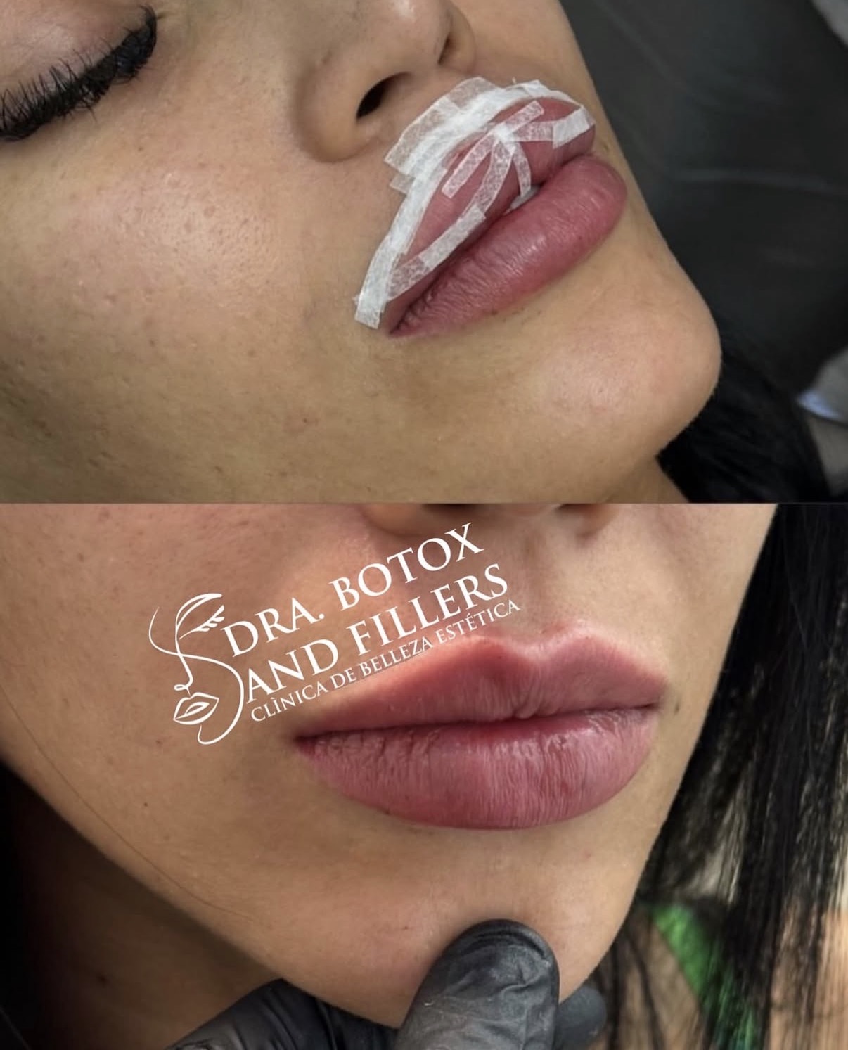 Relleno de labios: antes y después